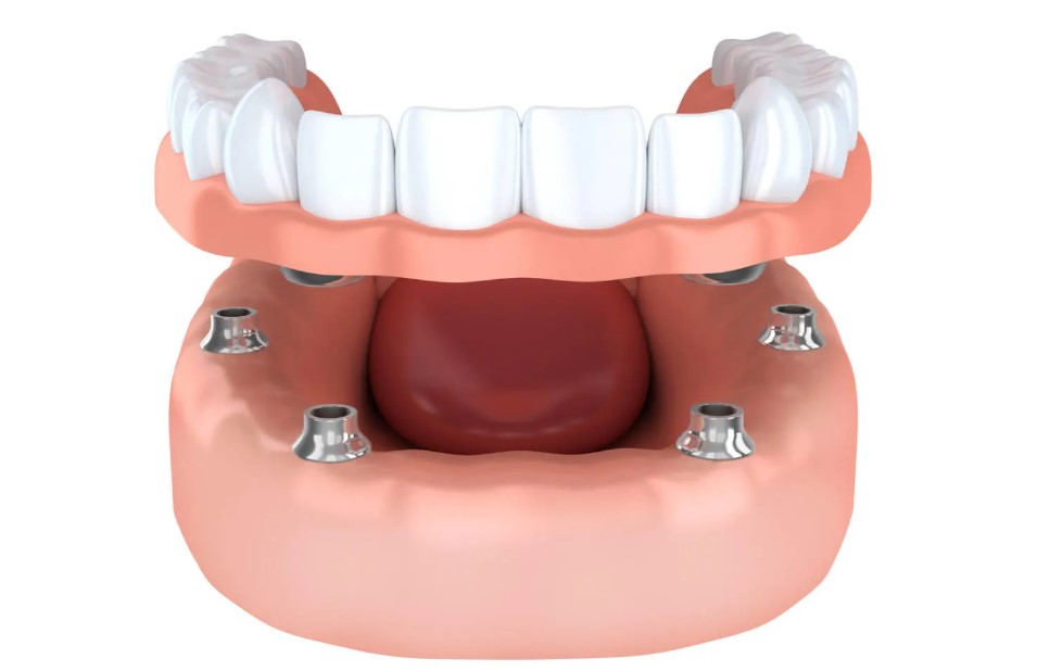 Cristaldent: la tua clinica di fiducia per l’implantologia dentale a Torino    